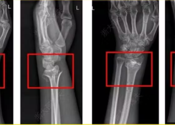 China diz ter revolucionado a ortopedia com ‘supercola óssea’ que resolve fraturas ‘em minutos’