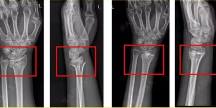 China diz ter revolucionado a ortopedia com ‘supercola óssea’ que resolve fraturas ‘em minutos’